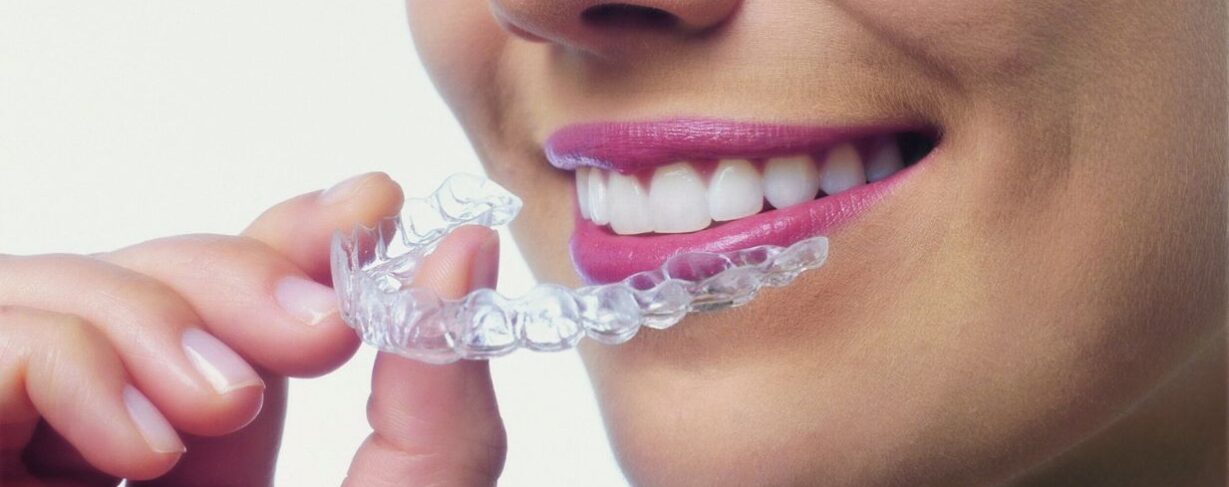 Gouttières Invisalign transparentes montrées en gros plan, utilisées pour le traitement orthodontique discret