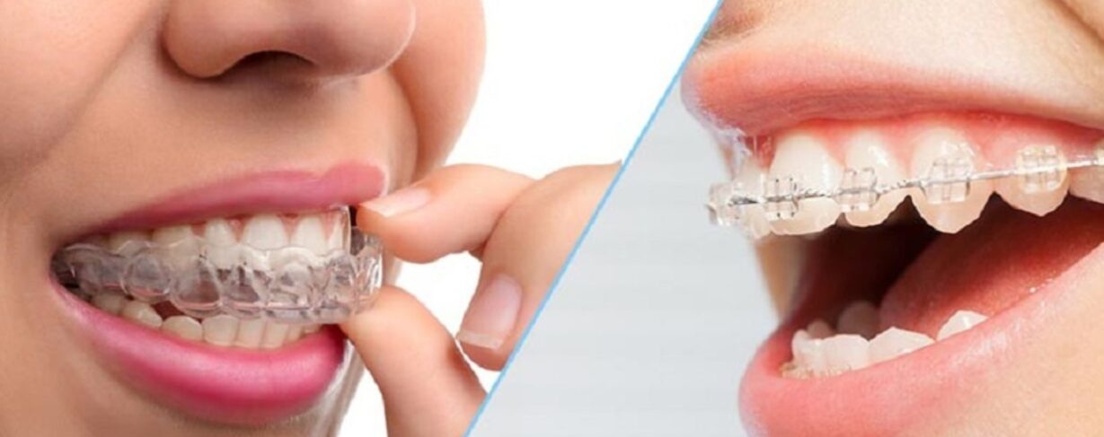 Comparaison entre les gouttières Invisalign transparentes et les bagues orthodontiques traditionnelles, illustrant les différences en matière de visibilité et de confort