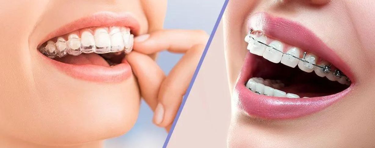 "Soins orthodontie – Appareils